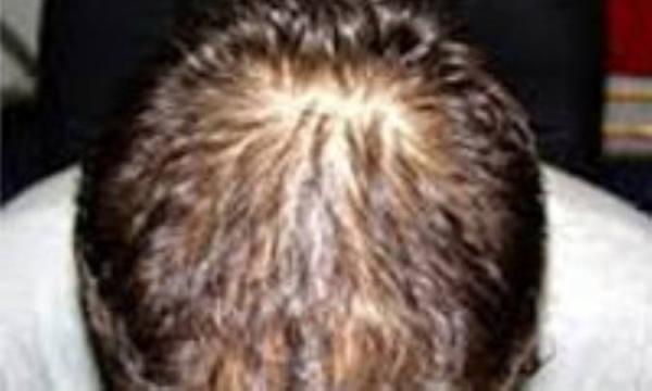 بیماریهای غیر معمول موی سر
